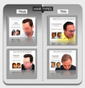Hair Types FUE VS Strip Hair Types FUE VS Strip