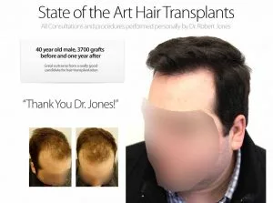 5 Secrets Care Hair Transplant 5 Secrets Care Hair Transplant