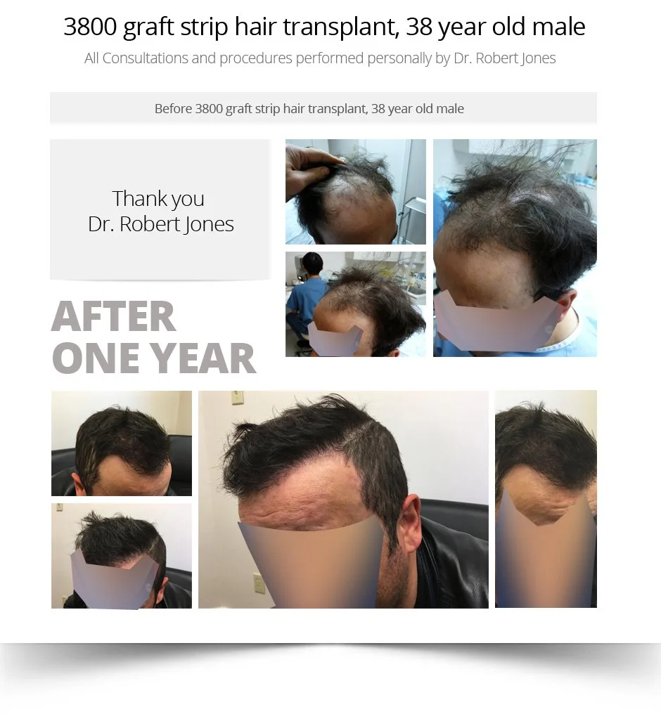 3800 Graft Strip Hair Transplant