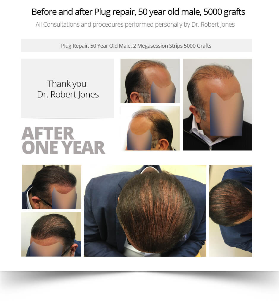 Before-and-after-Plug-repair-50-year-old-male-5000-grafts-1