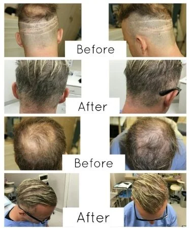 Hair Transplant Procedure at Toronto Hair Transplant Surgeons Hair Transplant Procedure at Toronto Hair Transplant Surgeons
