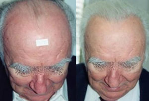 Before and After 1500 Follicular Units