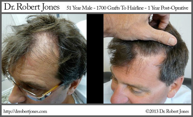 1700 Grafts Procedure Remarkable Results