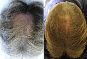 Before And After Graft Strip Surgery, 2000 Grafts