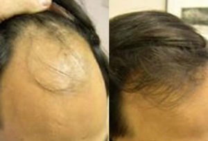 Before and After, 2000 Graft (35 Year Old male)