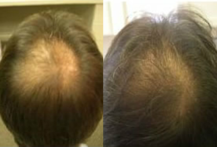 Before and After, 2000 Plus Grafts