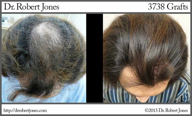 3738 Grafts