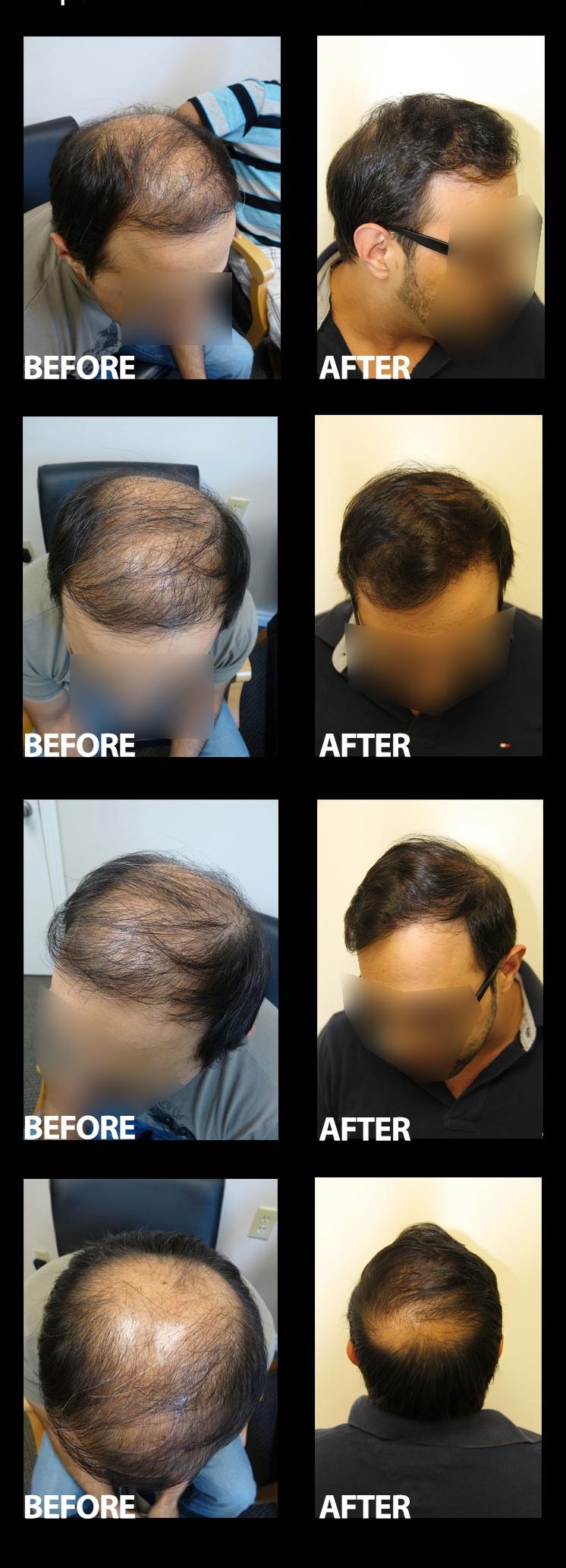Crown Procedure 3500 Grafts Before and After