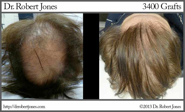3400 Graft Before and After Hair Restoration Procedure