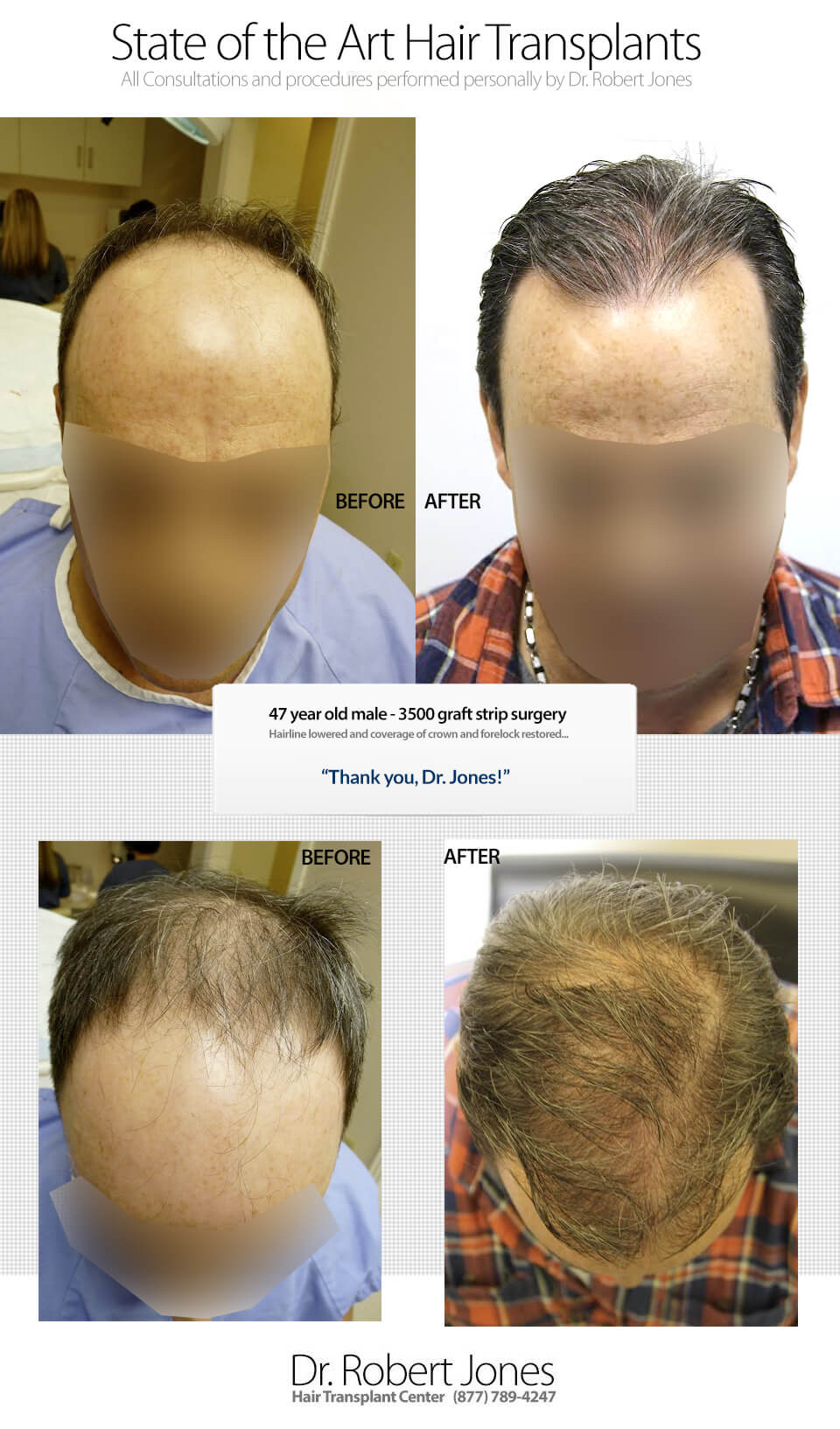 3500 Graft Strip Surgery 47 Yr Male