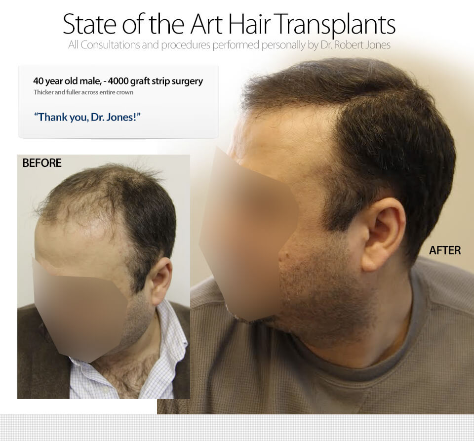 4000 Graft Strip Surgery 40 Year Old Male Video Case