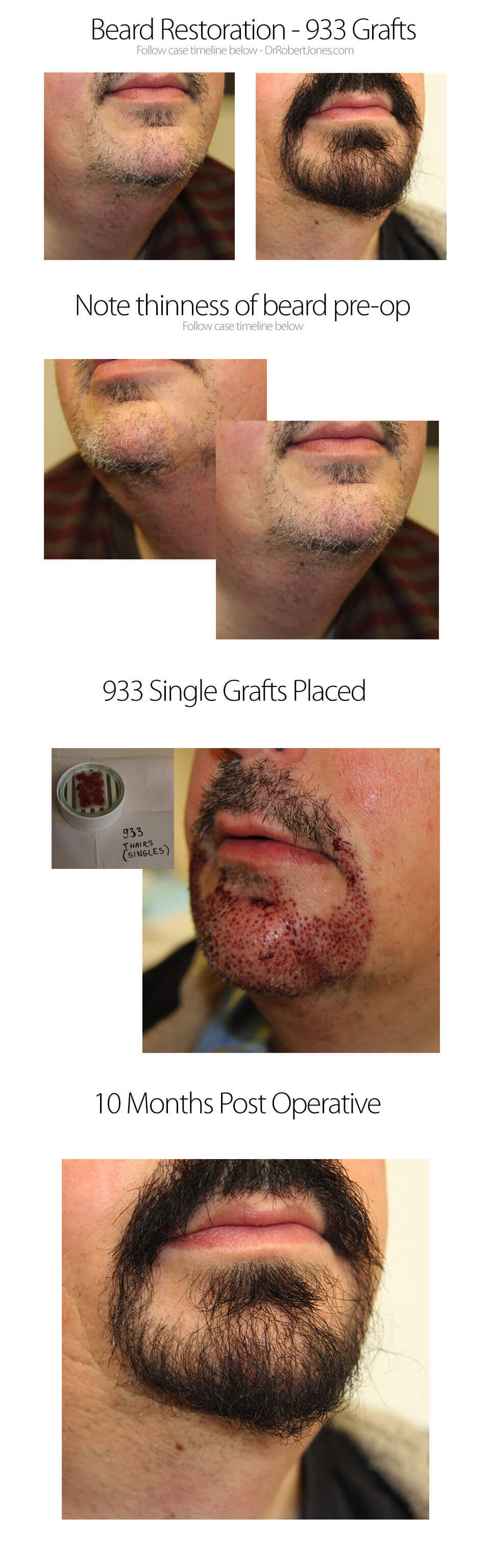 933 Grafts Beard Restoration