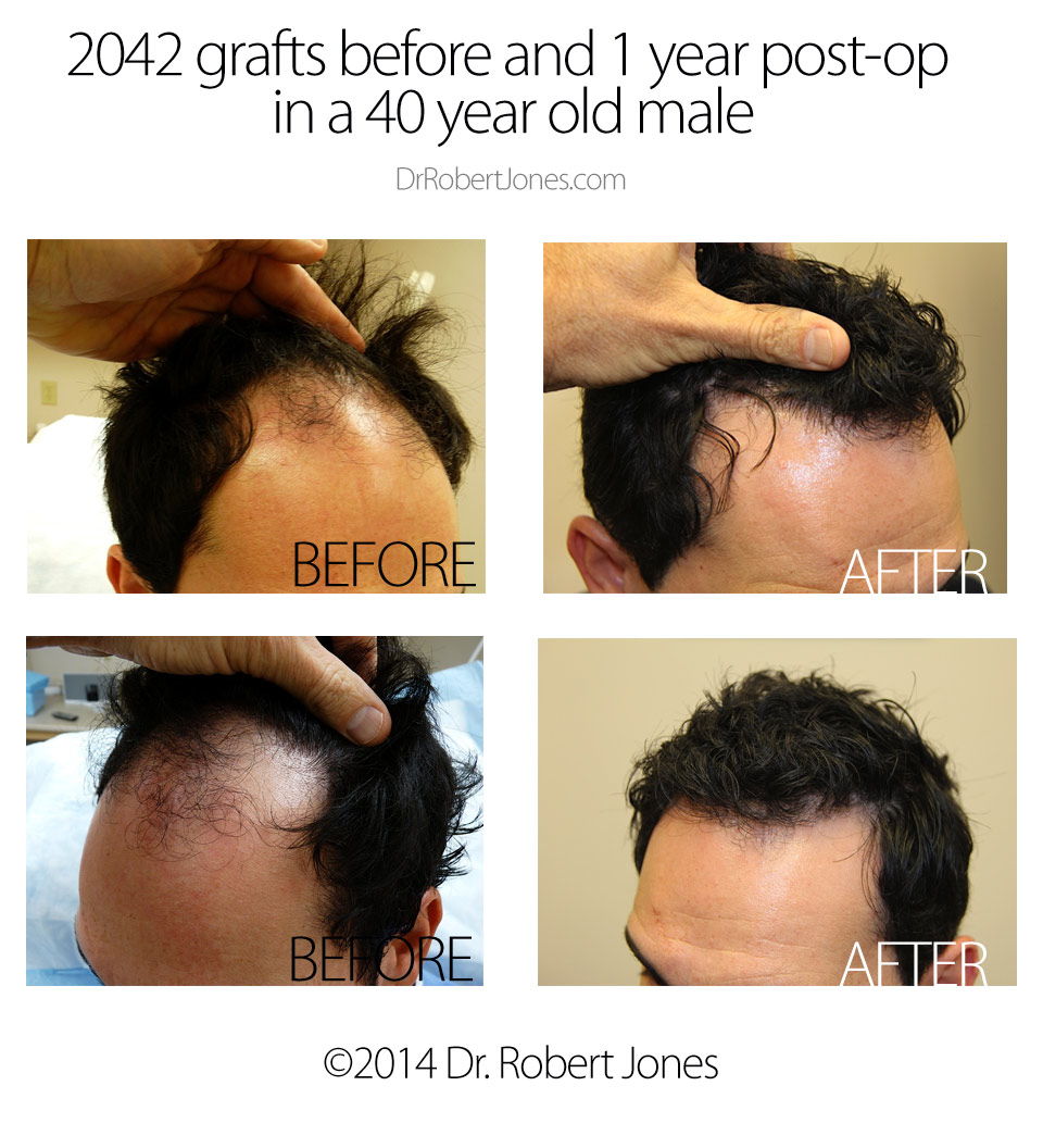 Before And After Hair Transplant Procedure, 2042 Grafts Before And After Hair Transplant Procedure, 2042 Grafts