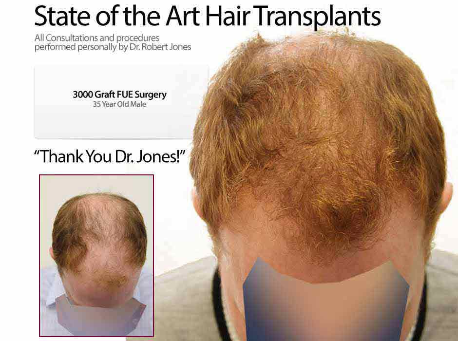 3000 Graft FUE Surgery 35 Yr Male