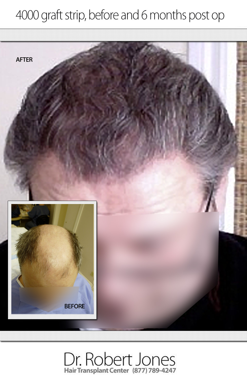 4000 Graft Strip Surgery 5 Month Results
