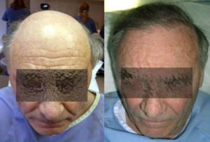 Before and After Grafts Strip Surgery, 2200 Grafts