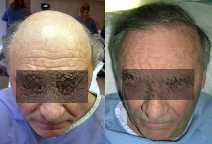 Before and After Grafts Strip Surgery, 2200 Grafts