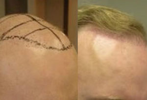 Before And After 2400 FUE Procedure