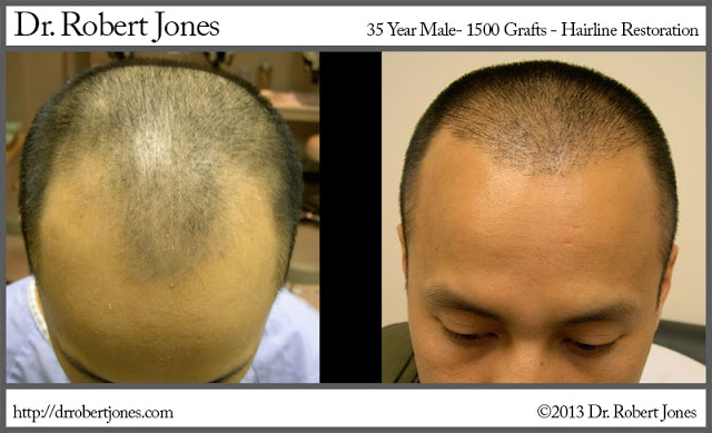 1500 Graft Hair Transplant 35 Yr Male