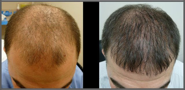 Crown and Hairline 40 Yr Male 3000 Grafts