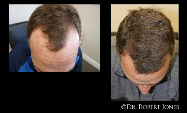 40 Year Old Male Fue One Year After Head On Shot