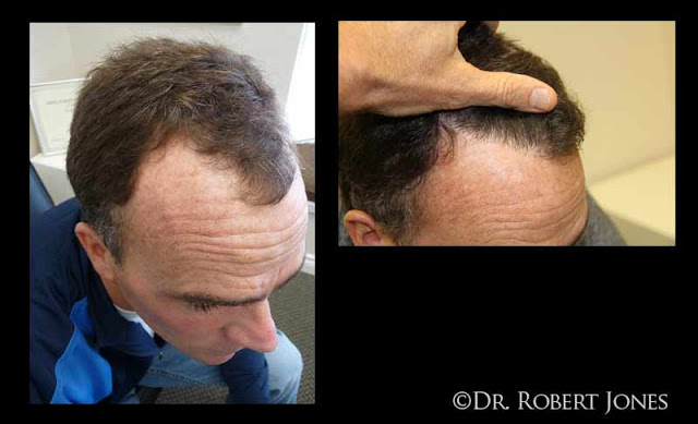 40 Year Old Male Fue 12 Months Results