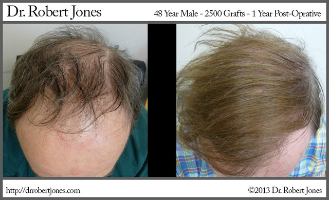 Hairline Restoration 2500 Grafts Amazing Results