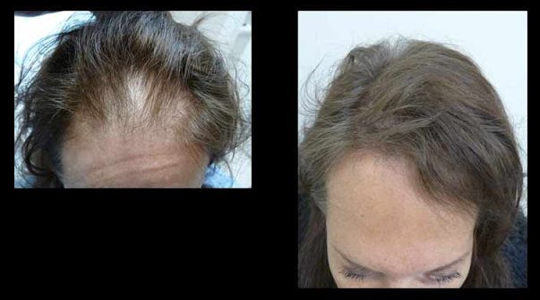 Female 50 Years 1500 Grafts Hair Restoration