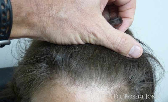 50 Woman Hair Case Thickness Comparison