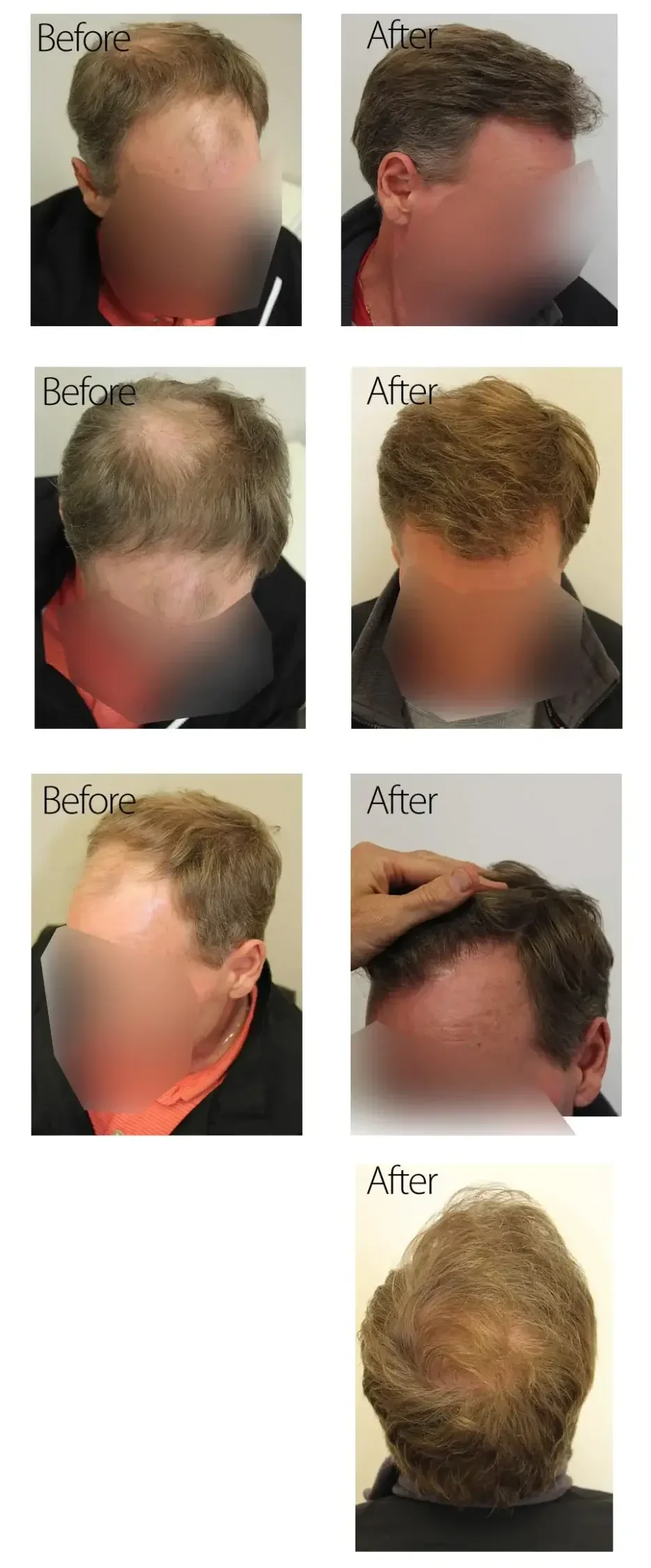 50 Year Old Male, Before And After Graft Strip Surgery,3078 Graft Strip 