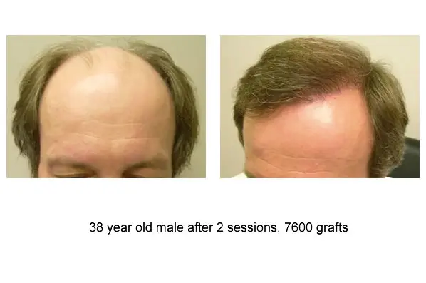 7600 Grafts Before And After,38 Year Old Male