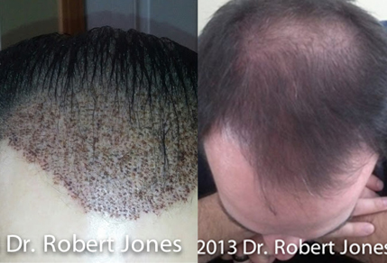 Case Study - Scott - 3000 Graft FUE