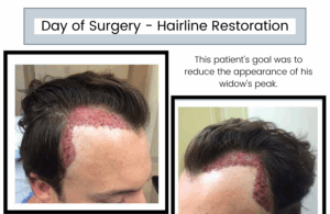 Day of Surgery - Hairline Restoration