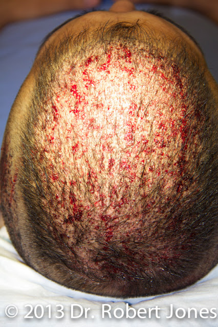 4000 Graft Fue Img 1927 Completion Phase