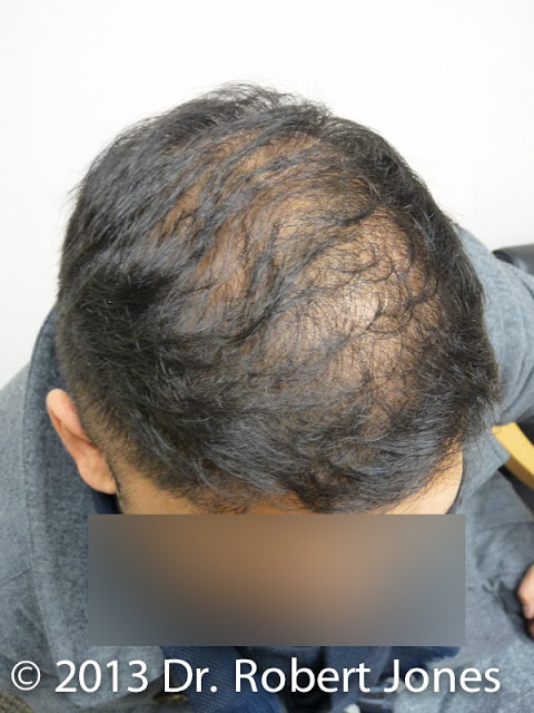 4000 Graft Fue P1080489 Donor Area Preparation