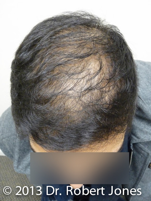 4000 Graft Fue P1080490 Extraction Process