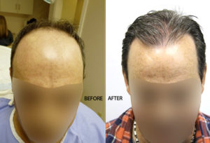 3500-Graft-Strip-Surgery-47-Year-Old-Male-FI