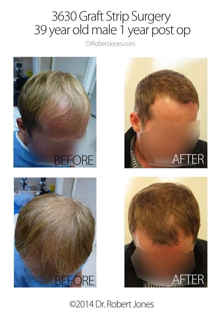 Before and After 3630 Graft Strip Surgery, 39 Year Old Male