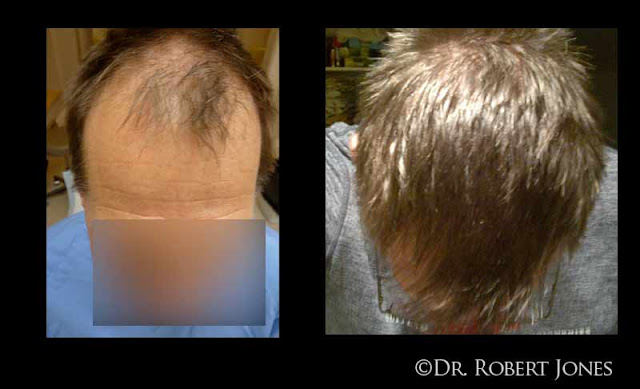 Before And After Hair Restoration Procedure, 48 Year Old Male, 4025 Grafts 