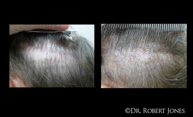 Micropigmentation Cases March 2013 Results