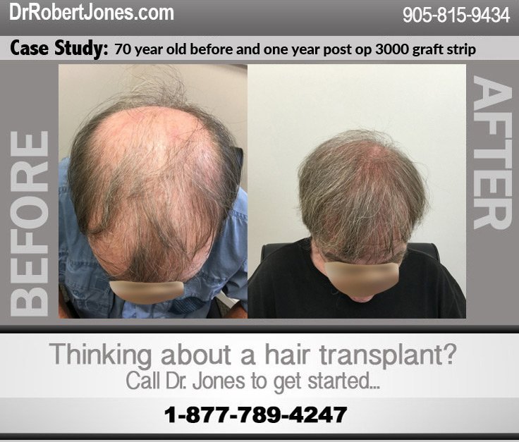 70 Year Old Before and One Year Post 3000 Graft Strip