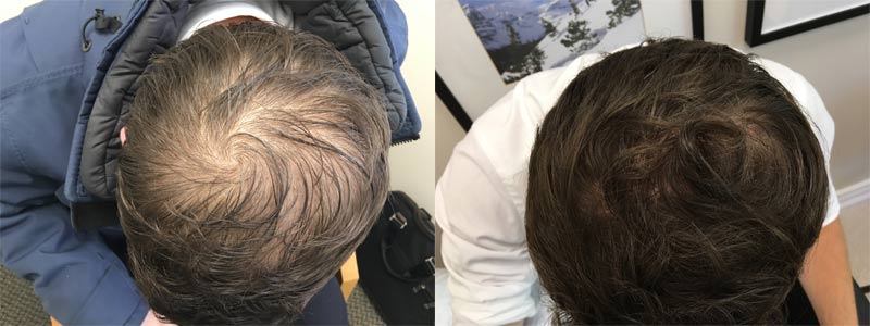 Before and After PRP