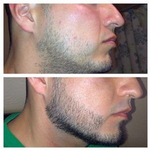 Minoxidil Beard Growth Treatment Men
