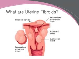 Fibroids and Hair Loss