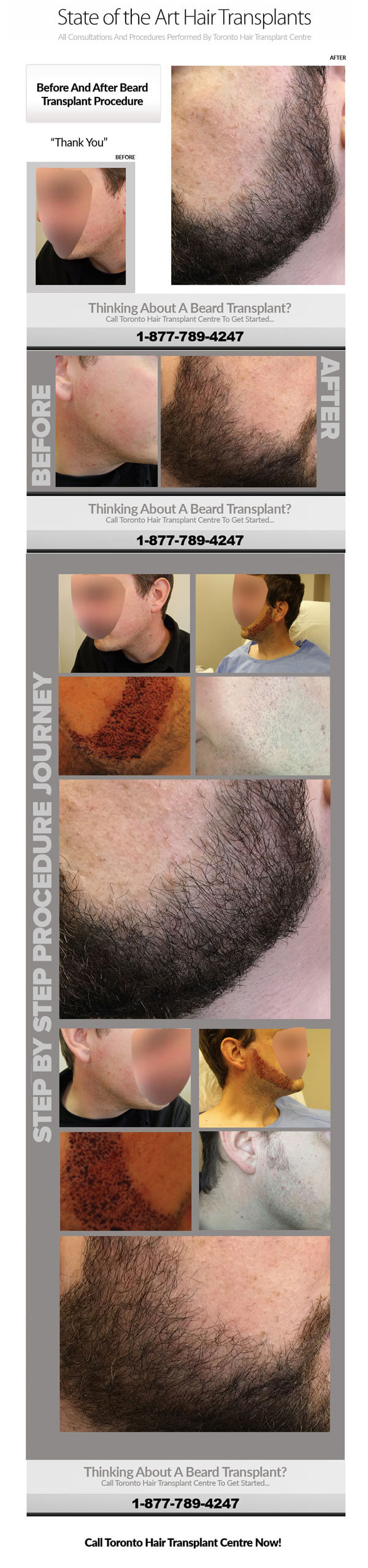Beard-Transplants-Case-Study