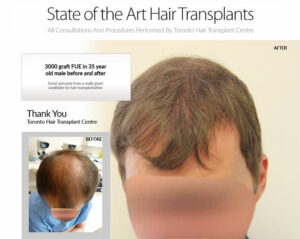3000 Graft FUE Before and After 3000 Graft FUE Before and After