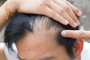 Effect of Fad Diets on Hair Quality Effect of Fad Diets on Hair Quality