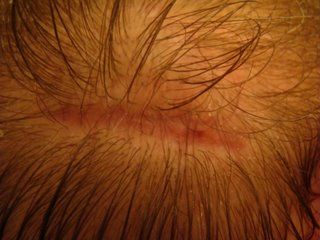 Acell Scar Repair Patient 12 Weeks Post OP Acell Scar Repair Patient 12 Weeks Post OP