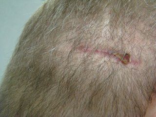 Acell Scar Repair Patient After Six Weeks Acell Scar Repair Patient After Six Weeks