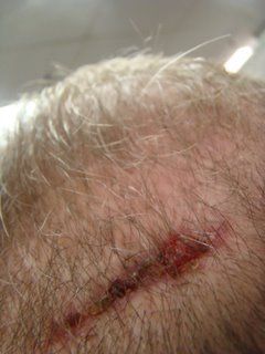 Acell Scar Repair Patient December 1 2008 Acell Scar Repair Patient December 1 2008